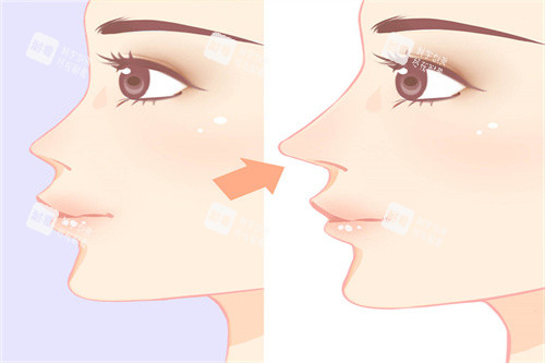 隆鼻手术前后展示图