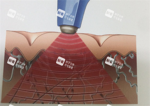 膨胀纹激光治疗过程