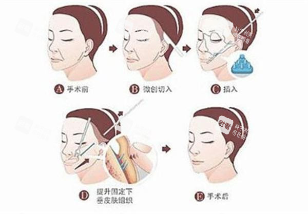 拉皮手术全过程