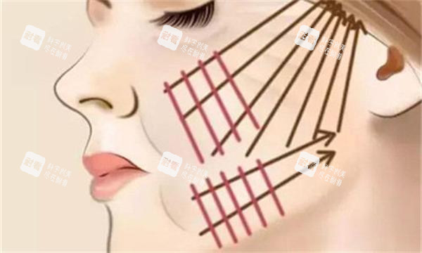面部拉皮划线图