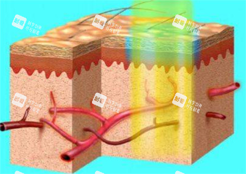 595染料激光治疗过程
