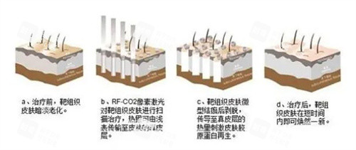 点阵激光治疗原理