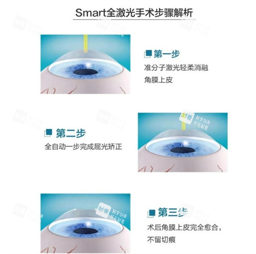 全激光smart手术步骤