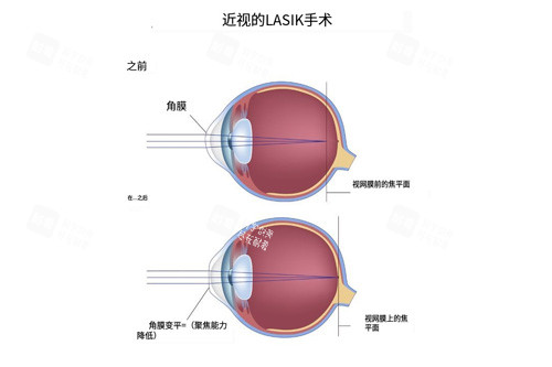 近视眼手术视线前后对比图
