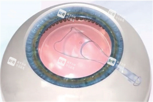 植入ICL晶体示意图