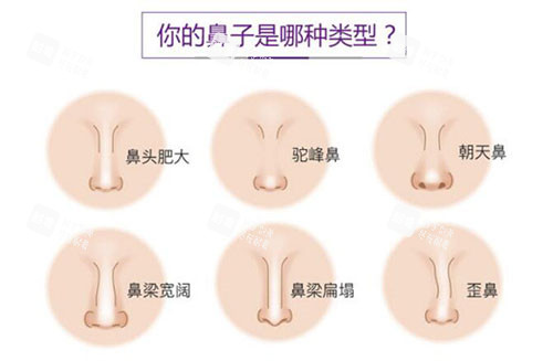 需要隆鼻常见鼻型