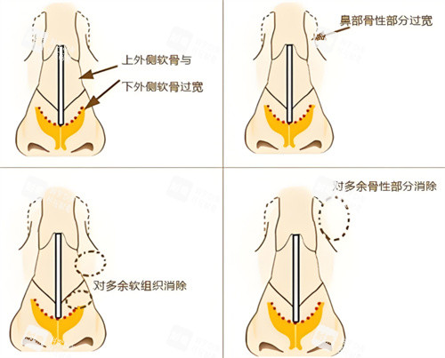 宽鼻矫正鼻骨原理