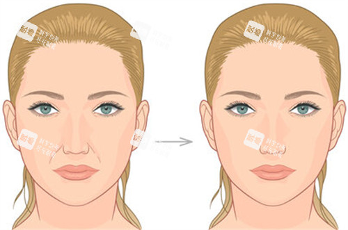 法令纹改善前后对比 法令纹改善前后对比