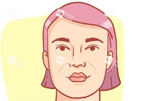 法令纹图片 法令纹图片