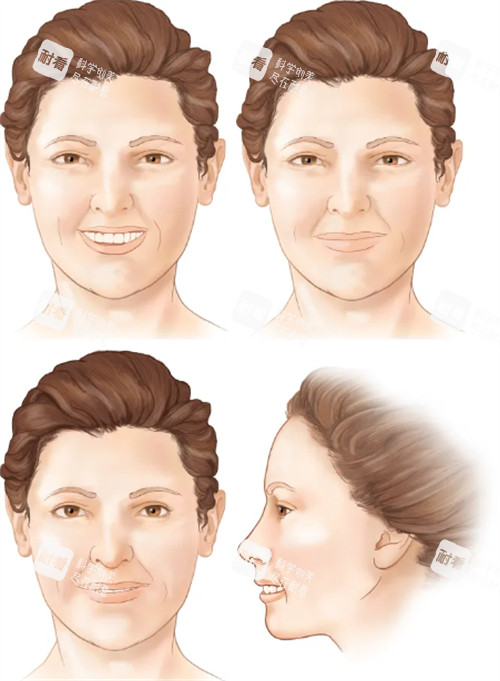 法令纹对面部整体影响 法令纹对面部整体影响