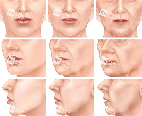 不同程度的法令纹