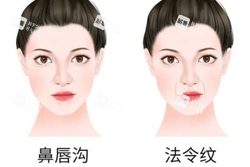 鼻唇沟和法令纹卡通对比图