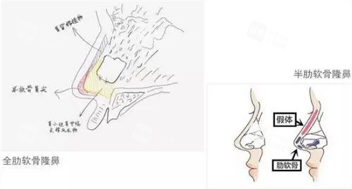 全肋和半肋隆鼻的区别图解 全肋和半肋隆鼻的区别图解
