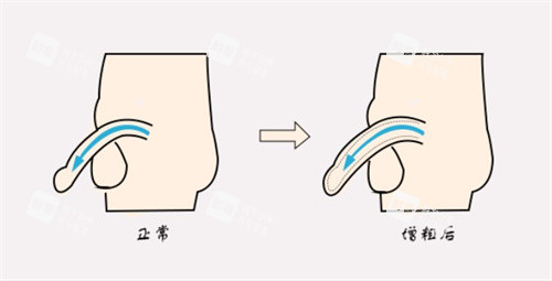 增粗术前后对比