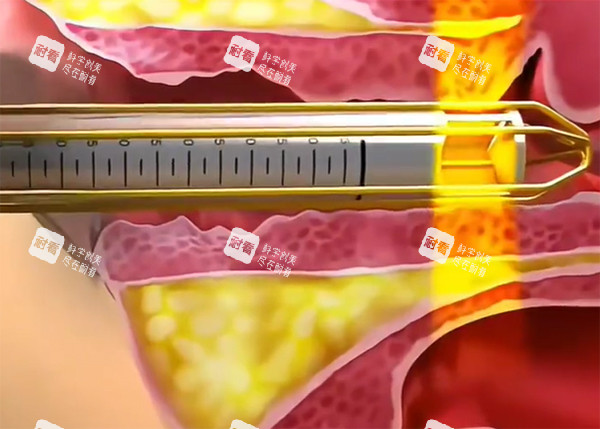 紧缩针推药示意图 紧缩针推药示意图