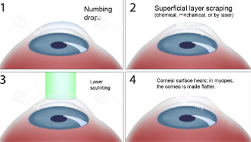 表层激光手术 表层激光手术