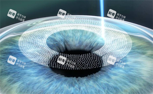 激光手术中 激光手术中