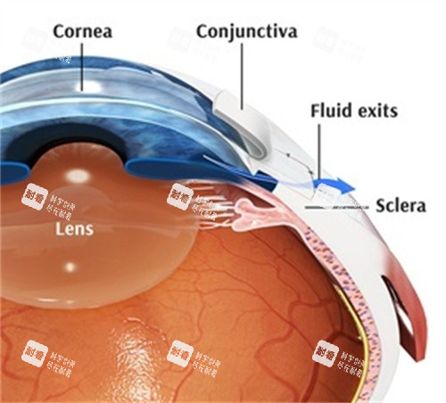 青光眼内部问题