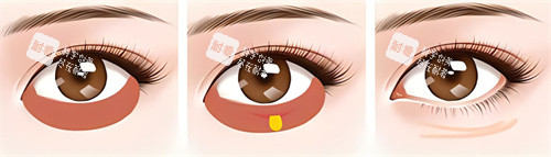 激光祛眼袋术过程