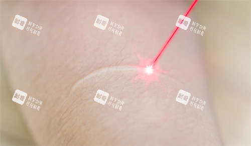 激光改善疤痕问题
