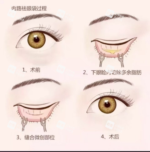 内路祛眼袋