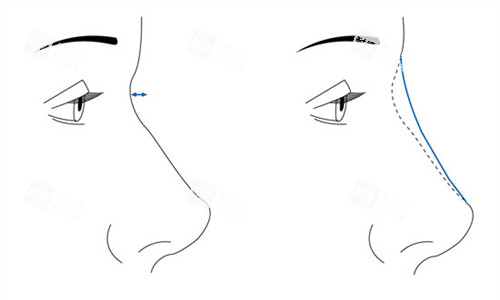隆鼻手术前后对比 隆鼻手术前后对比