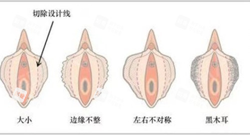 女性私密阴唇整形示意图
