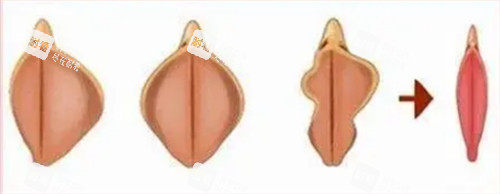 阴唇整形前后对比图