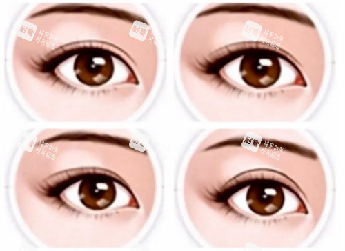 顾钏医生在上海口碑评价如何?深挖其眼整形技术获誉无数的背后逻辑!