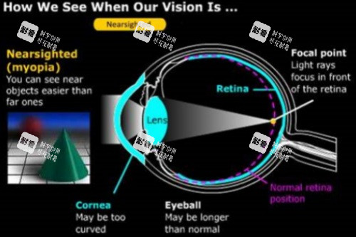 近视眼球结构