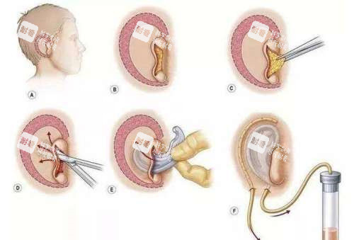 耳再造手术演示动画图