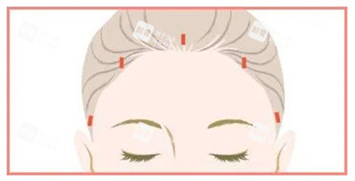 额头提升术切口