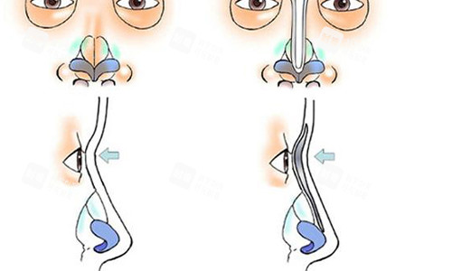鼻小柱延长的手术流程图