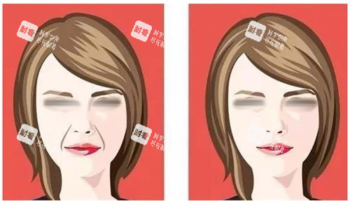 法令纹填充前后对比图