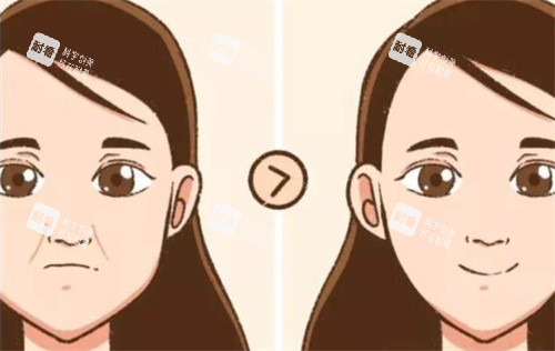 法令纹前后对比