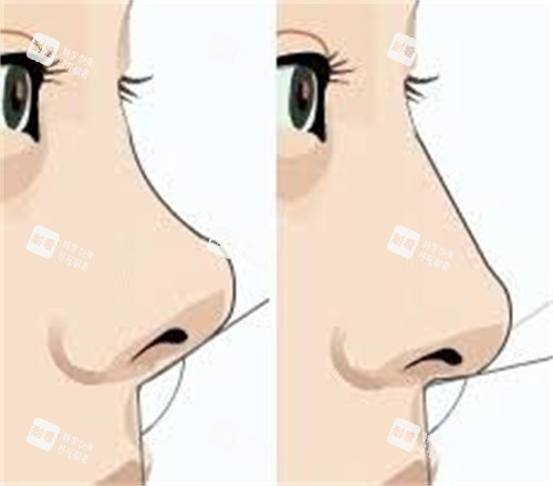 隆鼻手术膨体隆鼻前后对比