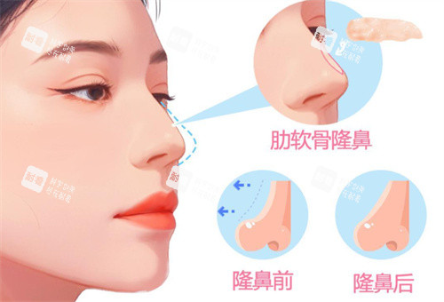 超肋骨隆鼻整形手术卡通图