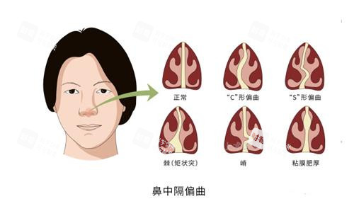 鼻中隔偏曲的类型 鼻中隔偏曲的类型