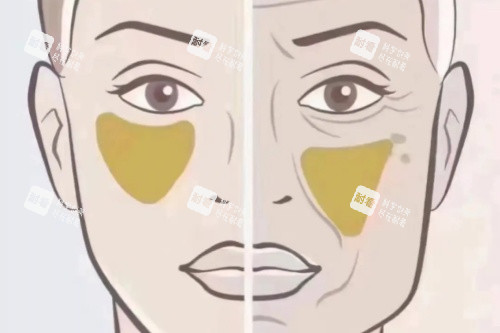 苹果肌下垂卡通对比图