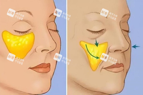 苹果肌下垂于正常苹果肌卡通对比图