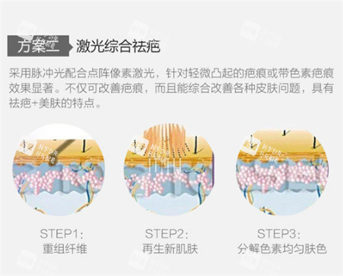 激光祛疤图示 激光祛疤图示