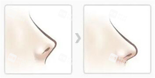 鼻子朝天矫正改善 鼻子朝天矫正改善