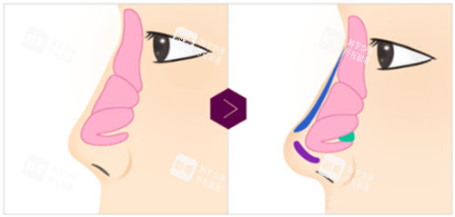 朝天鼻矫正前后对比 朝天鼻矫正前后对比