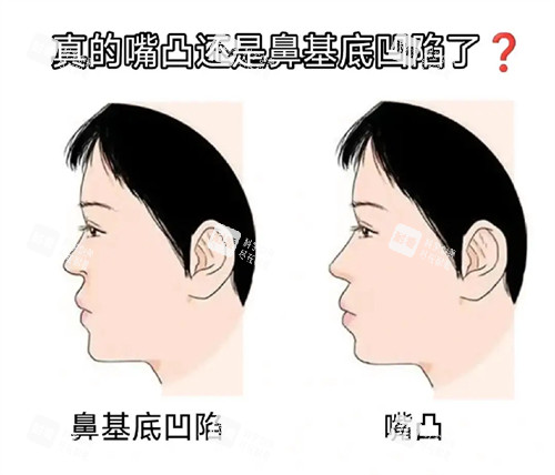 鼻基底凹和嘴凸 鼻基底凹和嘴凸