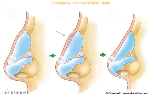 焦俊光肋骨鼻综合做得怎么样？真实实例展示，见证鼻部美丽蜕变