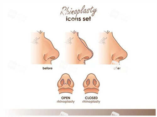 驼峰鼻矫正对比