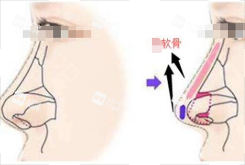 鼻小柱垫软骨侧面透视图