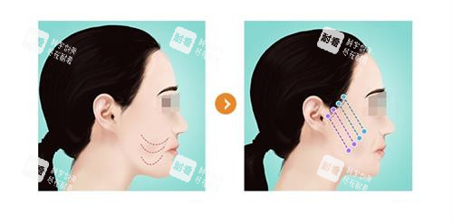 王春虎在北京的手术水平怎么样？做内窥镜筋膜提升技术好，在北京的认可度极高