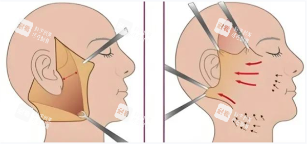 面部提升图 面部提升图