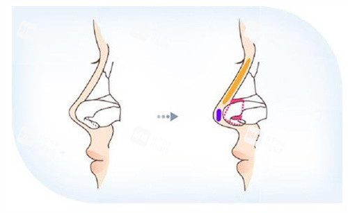 隆鼻手术 隆鼻手术